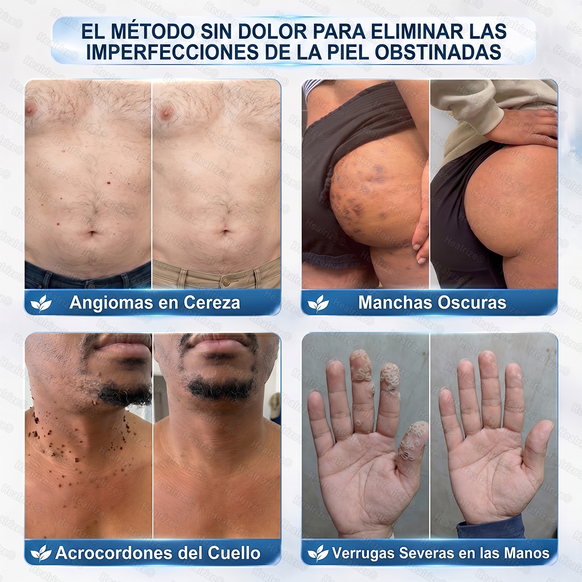 𝐑𝐞𝐜𝐨𝐦𝐞𝐧𝐝𝐚𝐝𝐨 𝐩𝐨𝐫 𝐅𝐚𝐫𝐦𝐚𝐜é𝐮𝐭𝐢𝐜𝐨𝐬🫐🫐𝑯𝗲𝙖𝐥𝒓𝗶𝙯𝗲® 𝐄𝐥𝐢𝐦𝐢𝐧𝐚𝐝𝐨𝐫 𝐝𝐞 𝐀𝐜𝐫𝐨𝐜𝐨𝐫𝐝𝐨𝐧𝐞𝐬 𝐲 𝐌𝐚𝐧𝐜𝐡𝐚𝐬 𝐞𝐧 𝟕 𝐃í𝐚𝐬🪄(𝐑𝐨𝐥𝐥𝐞𝐫𝐛𝐚𝐥𝐥 𝐒𝐢𝐧 𝐃𝐨𝐥𝐨𝐫 𝐲 𝐒𝐢𝐧 𝐂𝐢𝐜𝐚𝐭𝐫𝐢𝐜𝐞𝐬)👩‍⚕️
